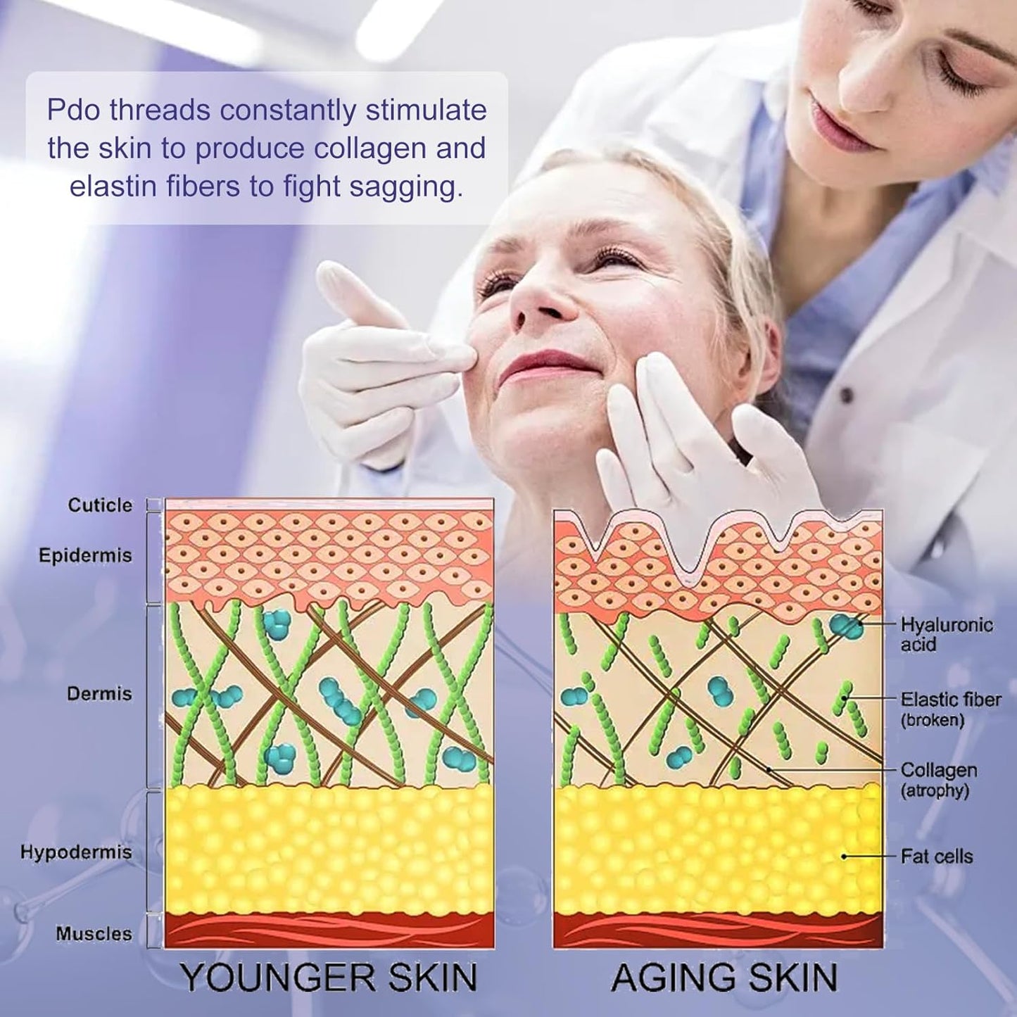 pdo threads collagen stimulation
