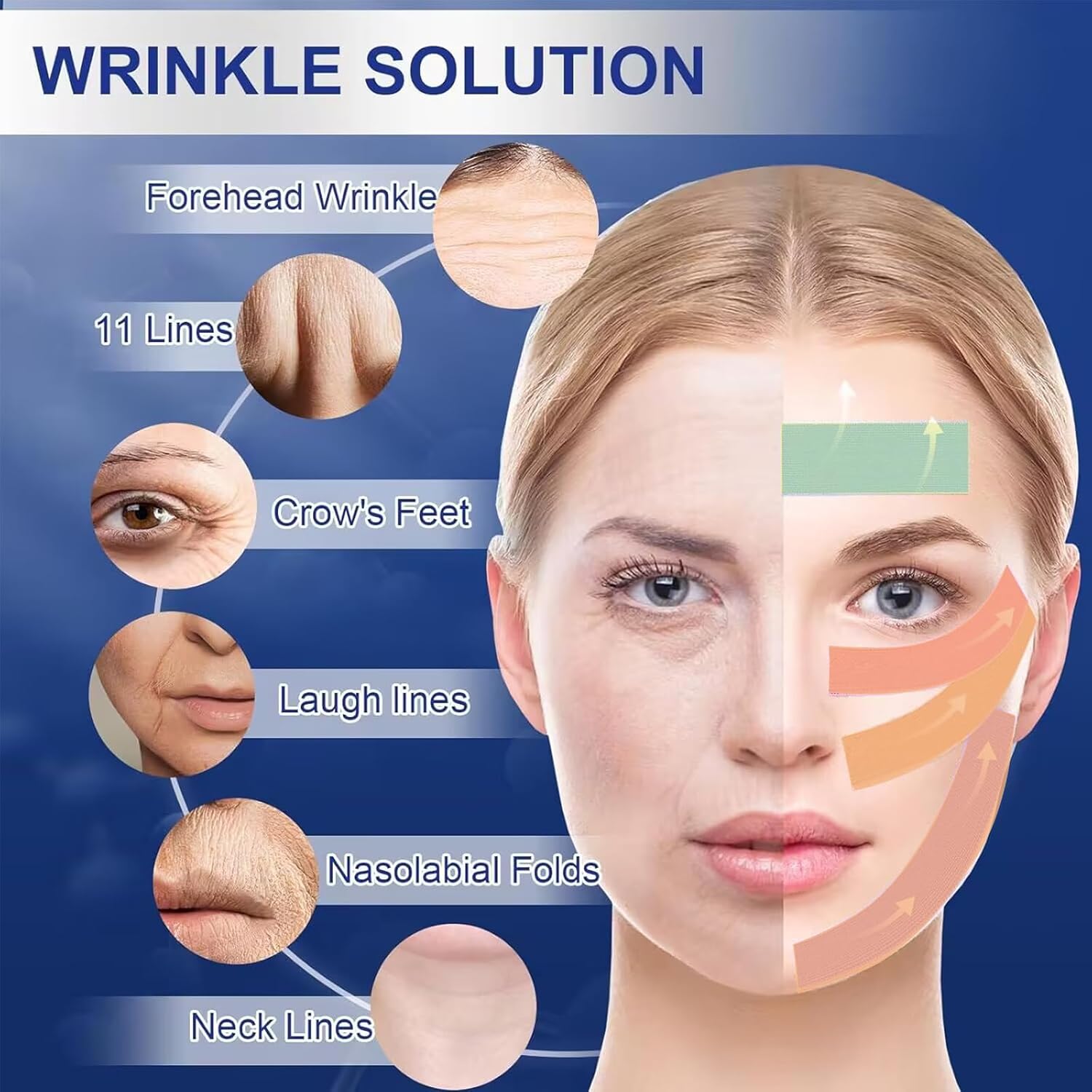 forehead nasolabial folds pdo threads