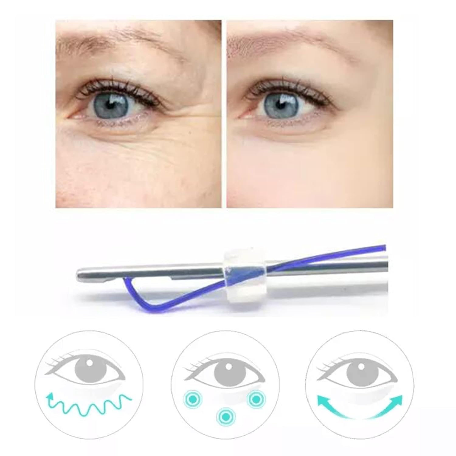 threads lifting for hooded eye,crow’s feet,tear grooves